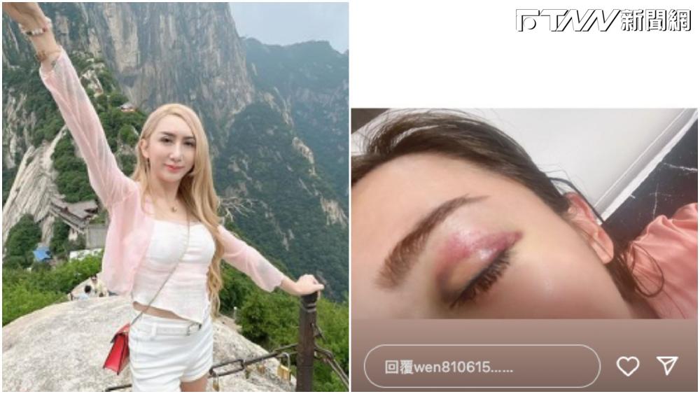 罔腰發文提到在與鳳梨交往期間，遭對方暴打。（圖／翻攝罔腰IG）